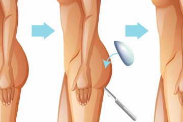 Gluteoplastia: Aumento de Glúteos com Prótese ou Gordura Enxertada?